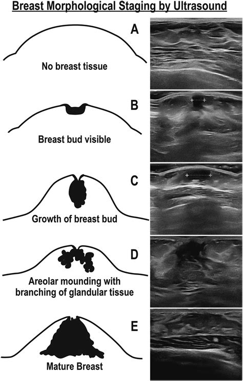 teen boob|Normal Breast Development and Changes